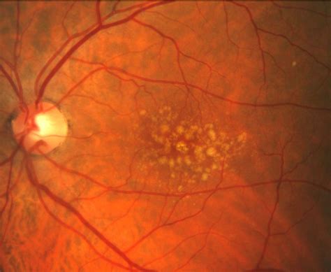 drusen mega|Retinal Drusen: Everything You Need to Know .